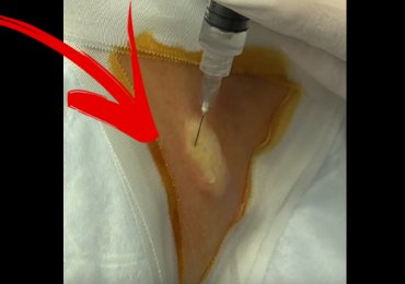 15-Year-Old Sebaceous Cyst Removal