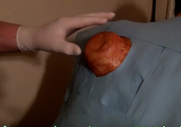 30 Year Old Cyst Popped