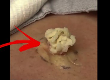 A Simply IrreCYSTable one! Epidermoid cyst removal