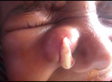 Abscess On Side Of Nose
