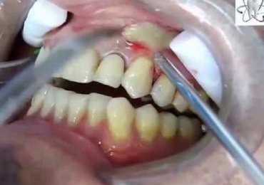 Dental abscess drainage…Abscess tooth removal