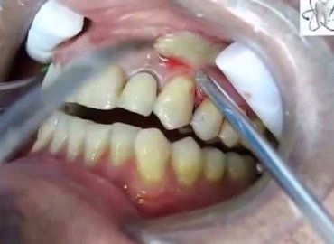 Dental abscess drainage…Abscess tooth removal