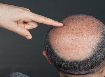 Epidermoid Cyst Removal From Scalp