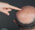 Epidermoid Cyst Removal From Scalp
