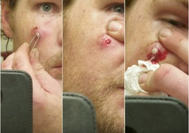 Guy pops huge abscess pimple on face 