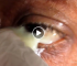 Lacrimal Eye Sac Abscess Drainage