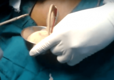 Must Watch – Back abscess River of Pus 