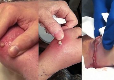 Three Huge Abscess one the hand