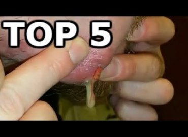 Top 5 abscess popping