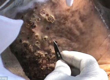 WATCH: Digging Out The Worst Worms inside Foot