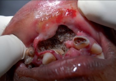 Watch: Worms Living inside teeth cavity removal