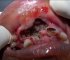 Watch: Worms Living inside teeth cavity removal