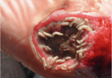Worst Maggots in wounds coming out after removed and treatment