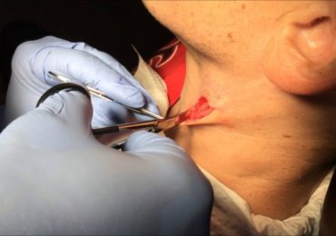 Basal Cell Carcinoma Excision at the neck 