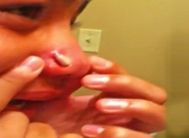 Crazy Nose Pimple Popped