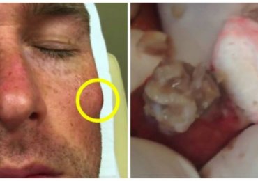 Dermatologist explodes a disgusting face cyst