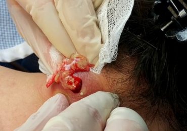 Drainage of Infected Epidermal Cyst from mother’s neck