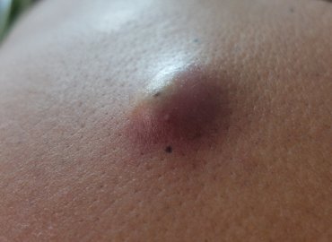 Draining Infected Cyst On Patients Back