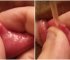 Huge Lip Pimple Explosion