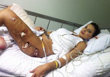 Model’s Butt and Legs Fake Implants Exploded Inside Her
