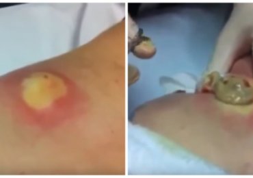 OMG This Cyst Popping is just too much!!