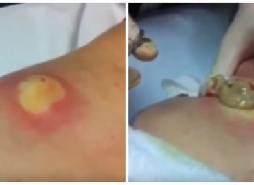 OMG This Cyst Popping is just too much!!