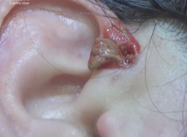 Removal Huge Cyst from the women ear 