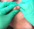 Removing a Huge Cyst on my boyfriend’s face