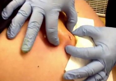 Strong pimple popping removal on back 