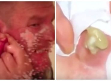 The 8 Grossest Pimple-Popping Videos of All Time