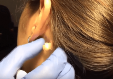 The Best Neck Cyst