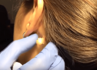 The Best Neck Cyst