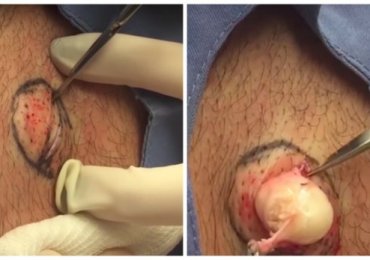 This Latest Dr Pimple Popper Will Put You Off Mozzarella Forever
