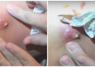 This Viral Pimple Popping
