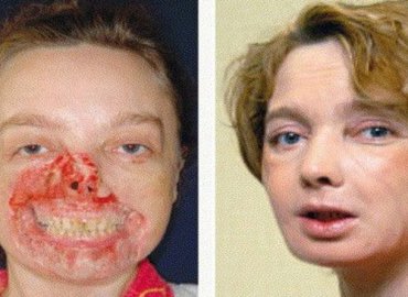 Watch: The World’s First Face Transplant