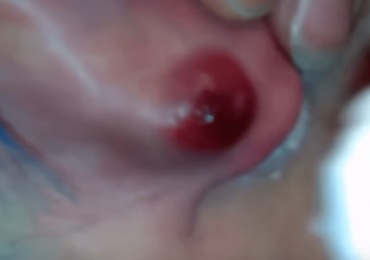 Weird Looking Pimple Popped