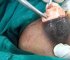 Big Size Fibrodenoma Removal Under Local Anesthesia