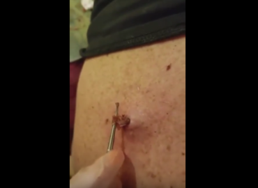 Biggest dilated pore of winer ever