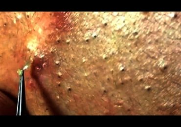 Blackhead Squeezed Pimple Removal 