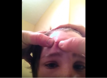 Disgusting Head Cyst Explosion
