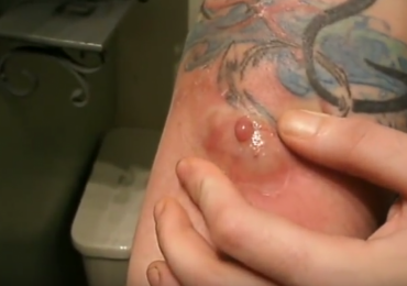 Drained abscess infection