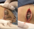 Epidermoid Cyst Removal By Dr. Sandra Lee
