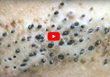 Extreme Blackheads – Oiliest Skin you’ll ever see