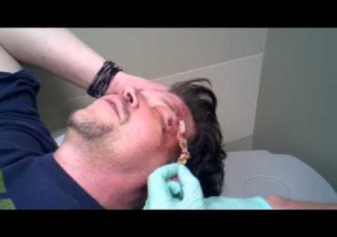 Head Wound Gauze Removal