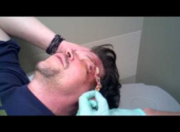 Head Wound Gauze Removal