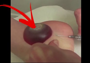 Huge foot blister due to the burning of a wart with liquid nitrogen