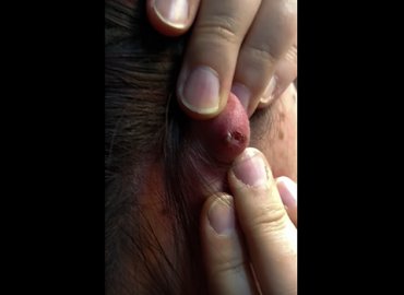 Infected ear getting popped