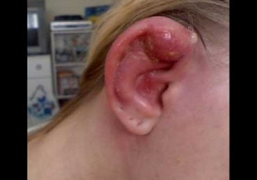Infected Ear Piercing