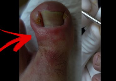 Infected ingrown toenail removal of deformed toe