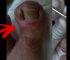Infected ingrown toenail removal of deformed toe